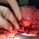 χειρουργείο νεφρού