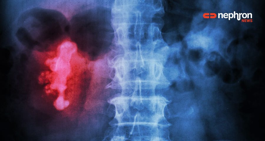 x-ray-kidney-stones