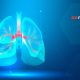 Σύστημα τεχνητής νοημοσύνης μπορεί να κάνει διαγνώσεις του καρκίνου των πνευμόνων έως ένα χρόνο νωρίτερα