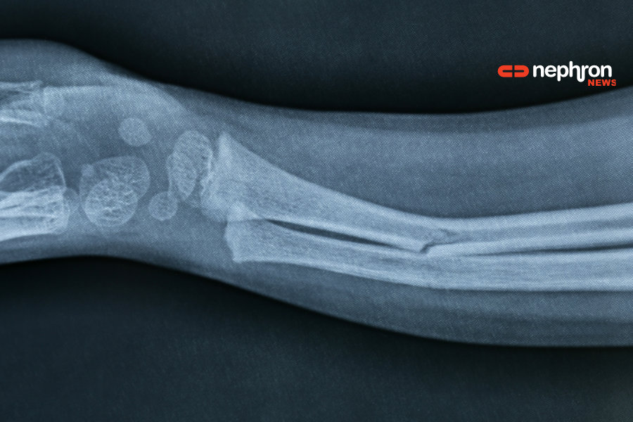 broken arm x ray